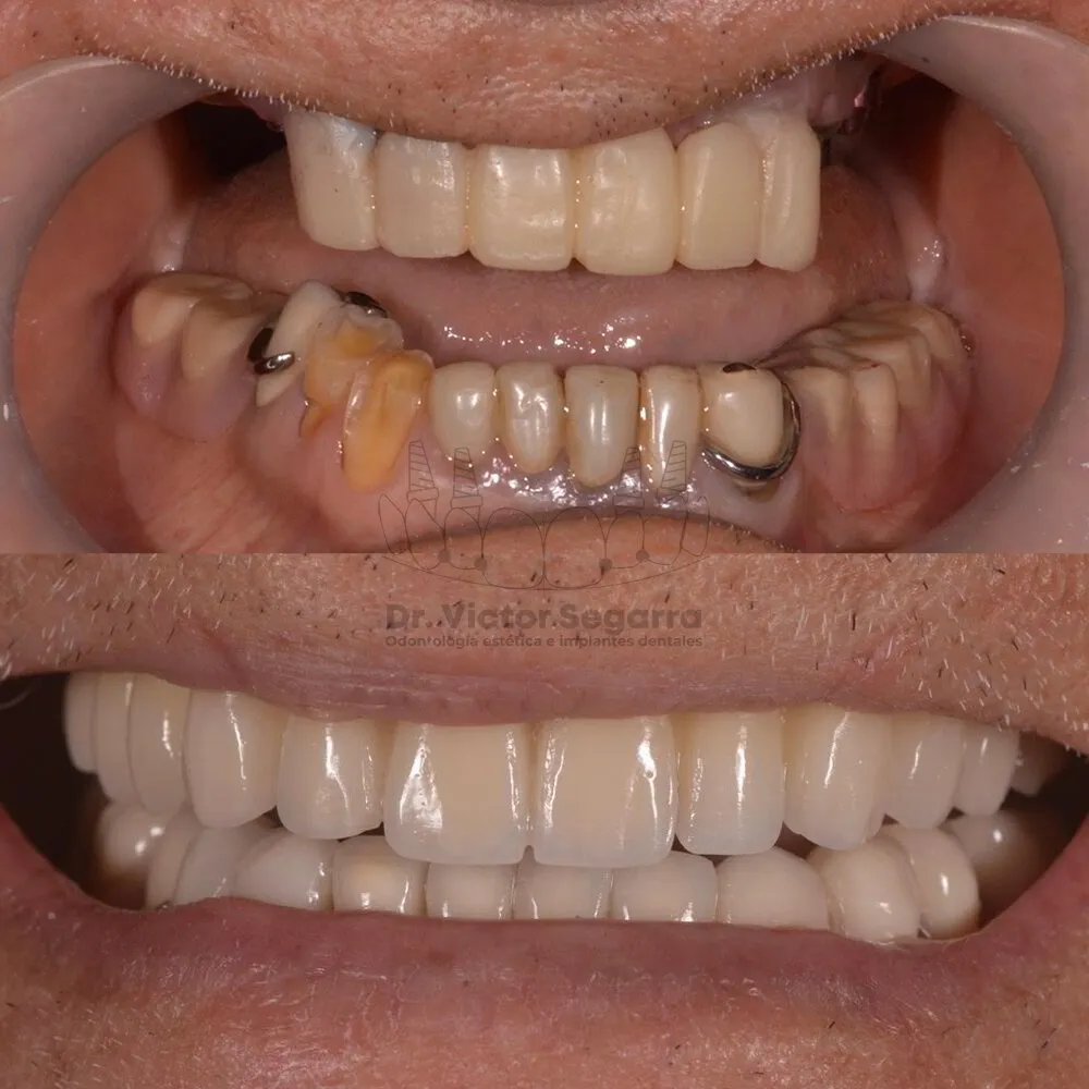 Antes y después Rehabilitación Oral Dr. Víctor Segarra
